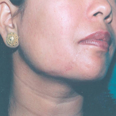 After-Black hairy nevus