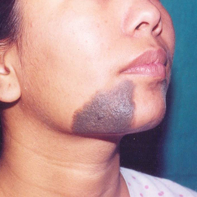 Before-Black hairy nevus