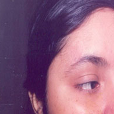 After- White patches (leucoderma)