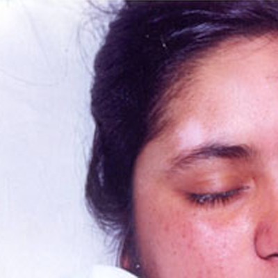 Before- White patches (leucoderma)