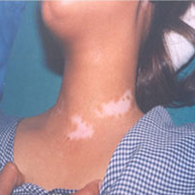 Before-White patches leucoderma