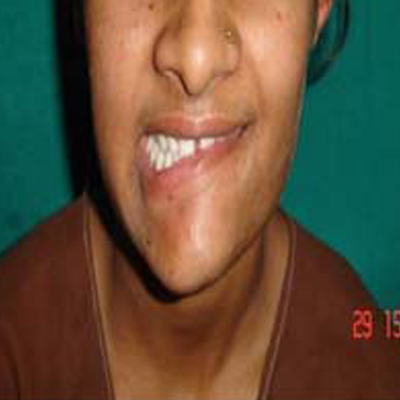 Before-Facial paralysis