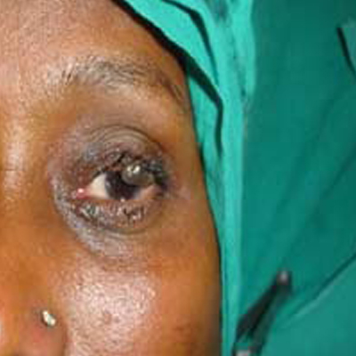 Before-Tumors of eyelids