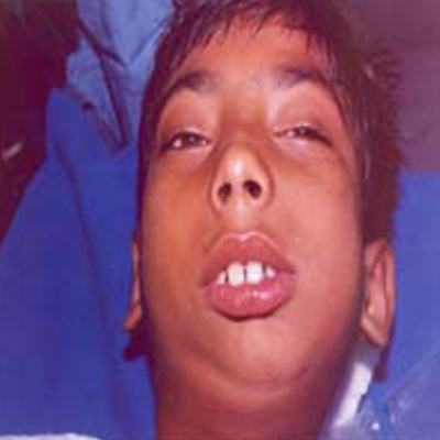 Before-TMJ ankylosis